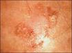 Queratosis actinica | Patologias Dermatologicas
